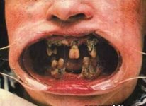 tooth-decay-rotting-teeth-dentist.jpg